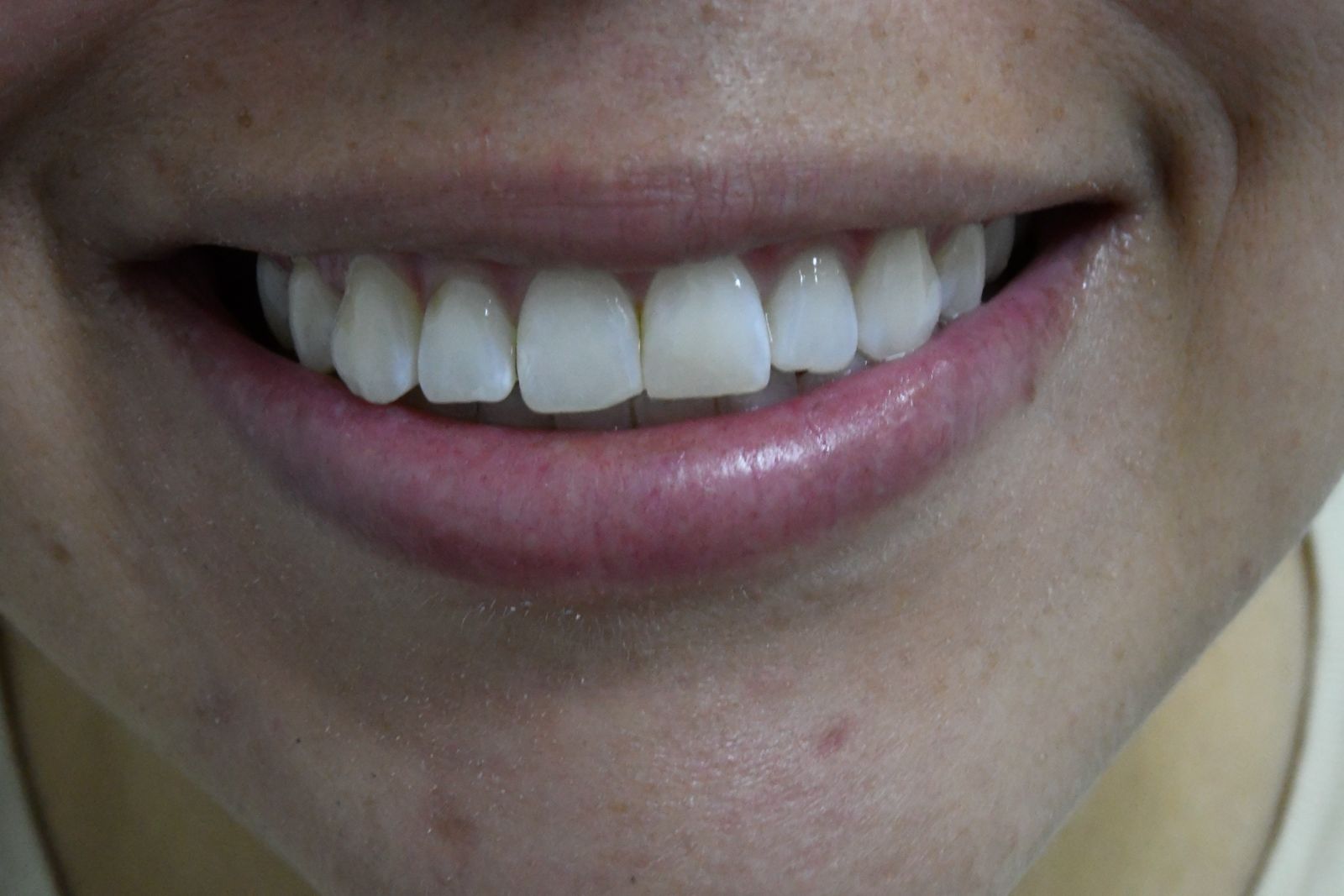 Después — Blanqueamiento + Tratamiento de sonrisa gingival con Botox